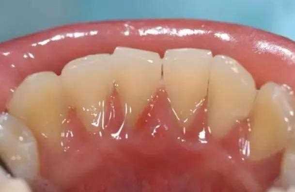 洗牙会不会造成牙齿松动 洗牙以后牙齿松动怎么办