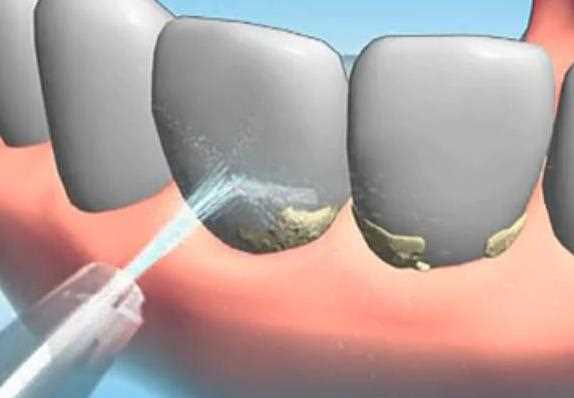 超声波洗牙后怎么保养 什么是超声波洗牙