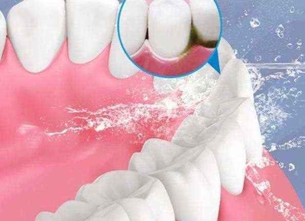 超声波洁牙后多久可以刷牙 洗完牙牙缝变大怎么办