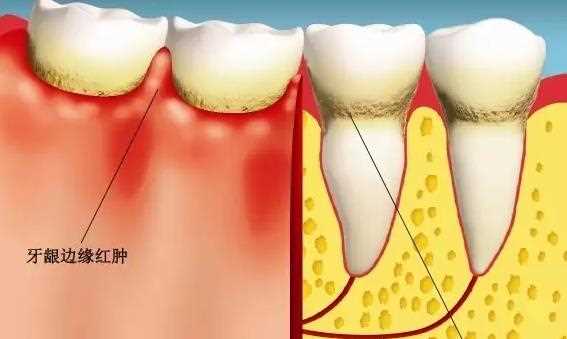 为什么会急性牙髓炎 急性牙髓炎怎么消炎