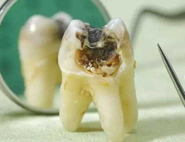 慢性牙髓炎能吃药治好吗 牙