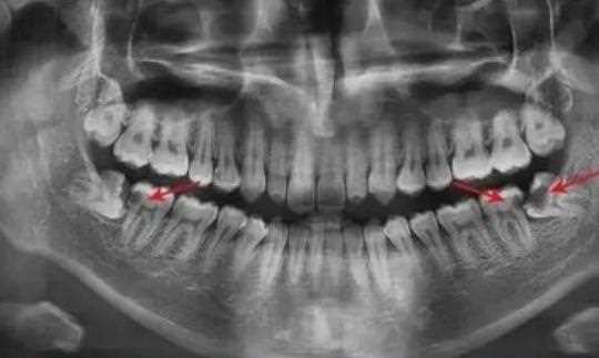 牙根炎和牙髓炎哪个严重 根尖周和牙髓炎的区别