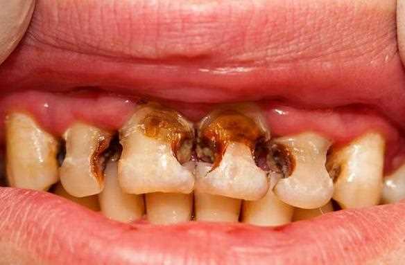 急性牙髓炎不治疗会怎么样 疼痛化脓发热牙齿松动