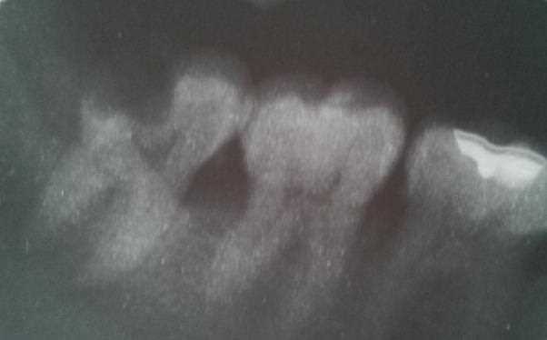 急性牙髓炎有叩痛吗 牙髓炎