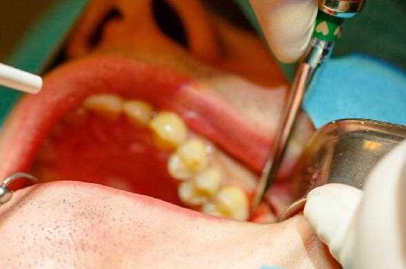 慢性牙髓炎和急性牙髓炎有哪