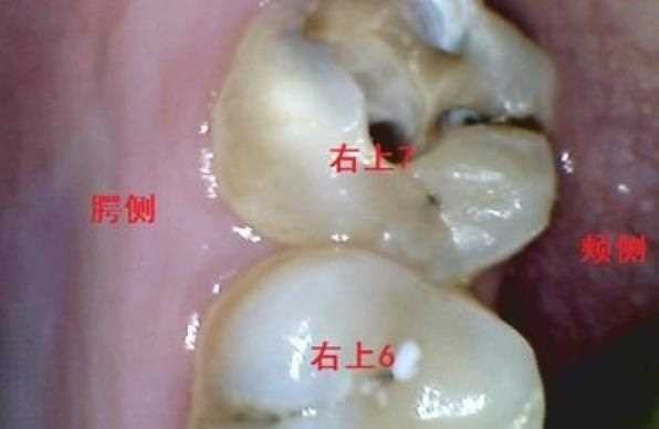 牙髓炎脓包能不能扎破 急性