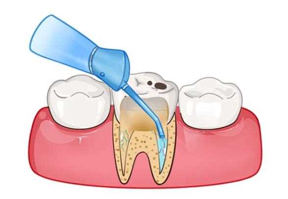 拍牙片能看出牙髓炎吗 牙髓炎x线下有哪些表现