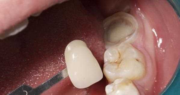 急性牙髓炎怎么消炎 急性牙