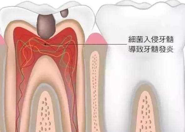 急性牙髓炎几天能好 急性牙