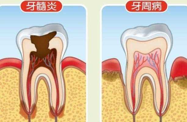 牙髓炎牙齿会脱落吗 牙髓炎