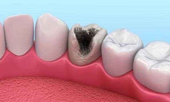 头孢地尼治牙髓炎吗 阿奇霉素可以治疗牙髓炎吗