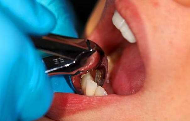 牙髓炎化脓期严重吗 牙髓炎
