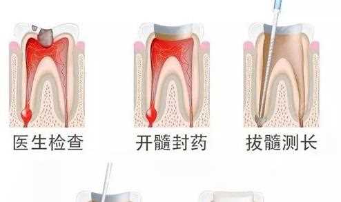 有牙髓炎的牙齿可以直接拔掉吗 组织坏死没有保留价