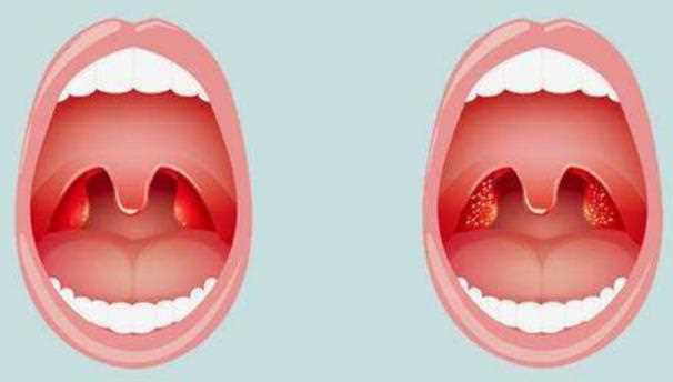 治疗咽喉炎可以吃哪些中成药 蒲公英能治慢性咽炎吗