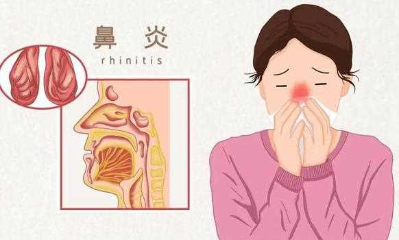 鼻炎好了鼻子会变小吗 鼻炎有哪些危害