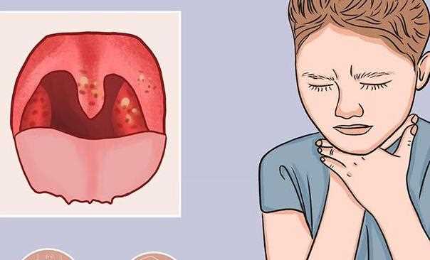 慢性咽炎跟肺有关系吗 咽炎跟扁桃体有关系吗