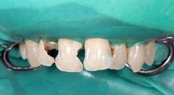 牙齿残根能修复吗 牙齿残根怎么恢复