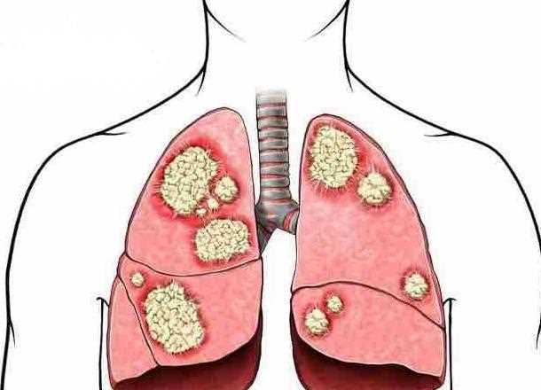 肺大泡能治愈吗 肺大泡怎么
