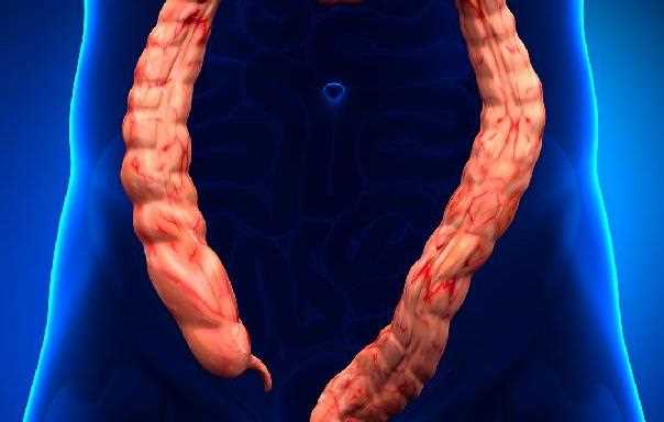 直肠癌早期有哪些症状 直肠