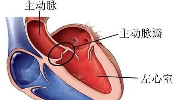 心脏瓣膜病有什么症状 心脏瓣膜病会心衰吗