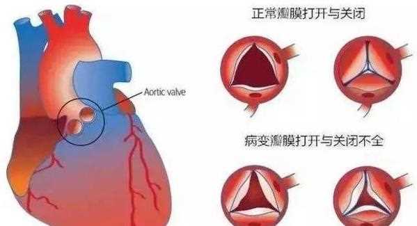 心脏瓣膜病可以吃药吗 心脏