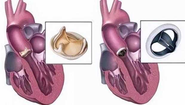 心脏瓣膜病有什么危害 心脏瓣膜狭窄有哪些并发症