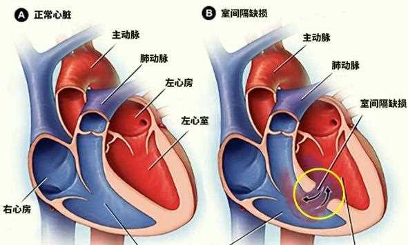心脏瓣膜置换术后能吃鱼吗 心脏瓣膜置换术后注意什