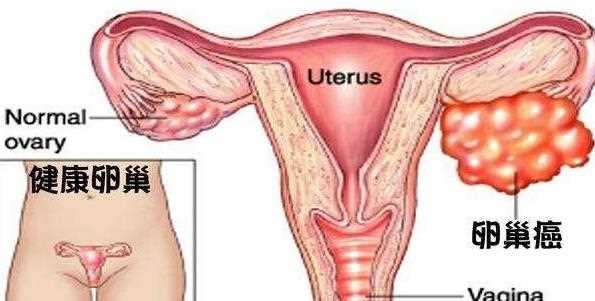 切除卵巢可以预防卵巢癌吗 如何预防卵巢癌复发