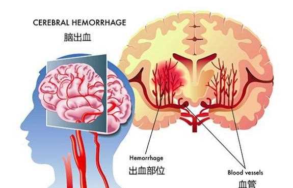 脑出血有哪些症状 脑出血手术后能恢复像正常人吗