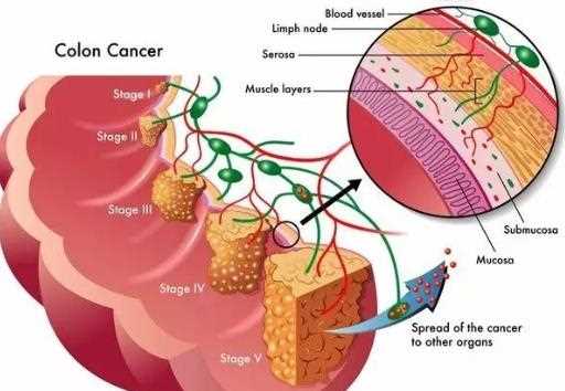 直肠癌的病因是什么 直肠癌如何确诊